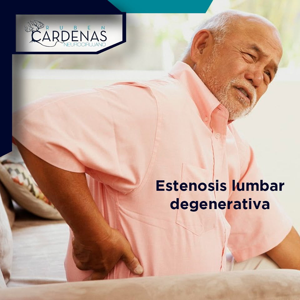 Estenosis lumbar degenerativa Estenosis lumbar degenerativa