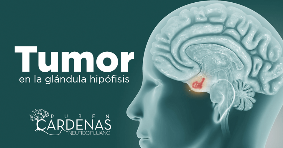 Tumor de hipófisis Tumor de hipófisis