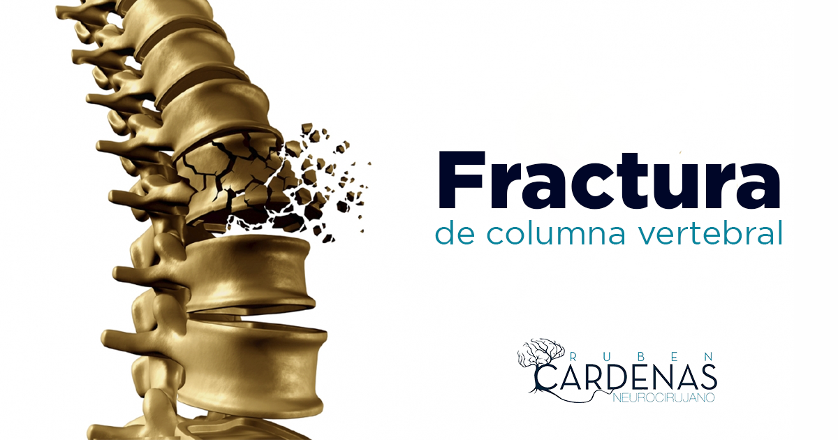 Fractura de columna vertebral | Dr. Ruben Cardenas